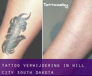 Tattoo verwijdering in Hill City (South Dakota)