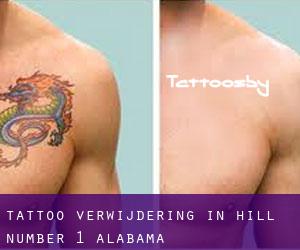 Tattoo verwijdering in Hill Number 1 (Alabama)