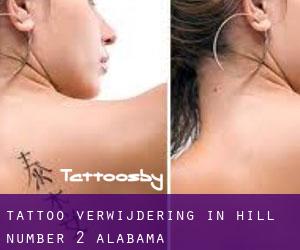 Tattoo verwijdering in Hill Number 2 (Alabama)