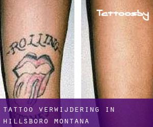 Tattoo verwijdering in Hillsboro (Montana)