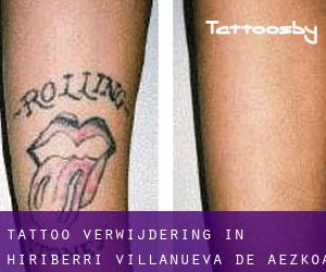 Tattoo verwijdering in Hiriberri / Villanueva de Aezkoa