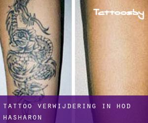 Tattoo verwijdering in Hod HaSharon