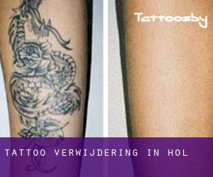 Tattoo verwijdering in Hol