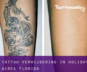 Tattoo verwijdering in Holiday Acres (Florida)