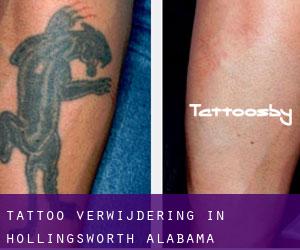 Tattoo verwijdering in Hollingsworth (Alabama)
