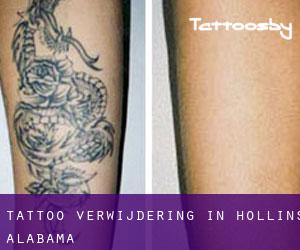 Tattoo verwijdering in Hollins (Alabama)