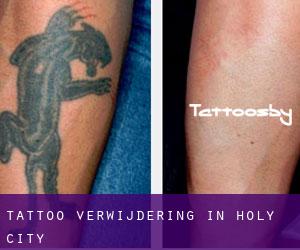 Tattoo verwijdering in Holy City