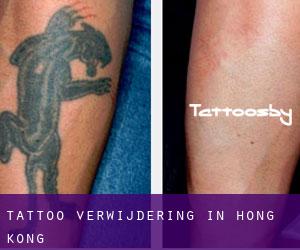 Tattoo verwijdering in Hong Kong