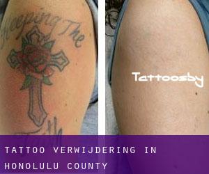 Tattoo verwijdering in Honolulu County