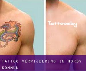 Tattoo verwijdering in Hörby Kommun