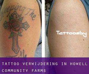 Tattoo verwijdering in Howell Community Farms