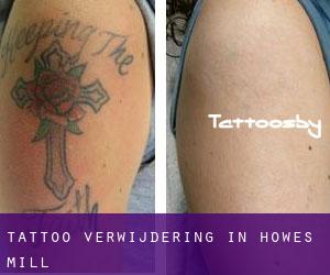 Tattoo verwijdering in Howes Mill