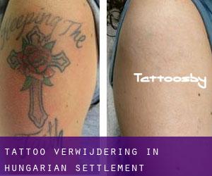 Tattoo verwijdering in Hungarian Settlement