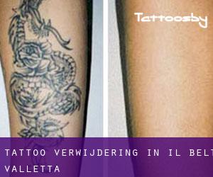 Tattoo verwijdering in Il-Belt Valletta