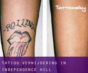 Tattoo verwijdering in Independence Hill