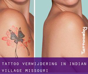 Tattoo verwijdering in Indian Village (Missouri)
