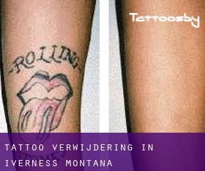 Tattoo verwijdering in Iverness (Montana)