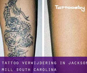 Tattoo verwijdering in Jackson Mill (South Carolina)