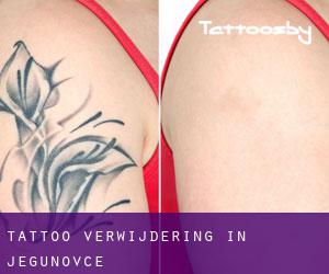 Tattoo verwijdering in Jegunovce