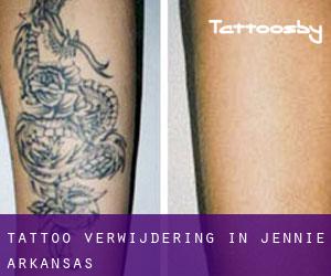 Tattoo verwijdering in Jennie (Arkansas)
