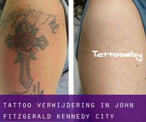 Tattoo verwijdering in John Fitzgerald Kennedy City