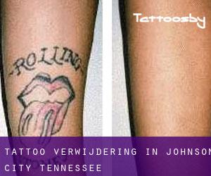 Tattoo verwijdering in Johnson City (Tennessee)