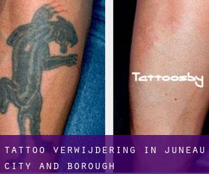 Tattoo verwijdering in Juneau City and Borough