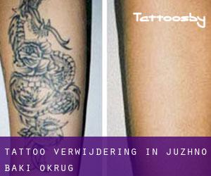 Tattoo verwijdering in Juzhno Bački Okrug