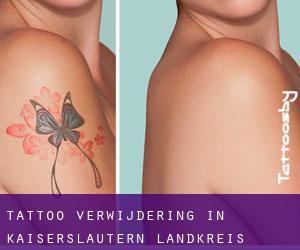 Tattoo verwijdering in Kaiserslautern Landkreis