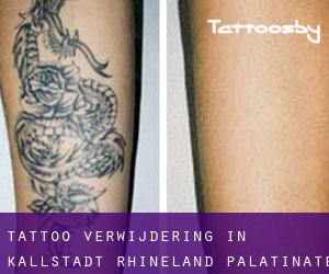 Tattoo verwijdering in Kallstadt (Rhineland-Palatinate)