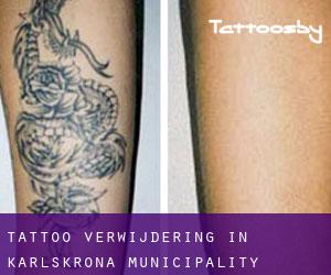 Tattoo verwijdering in Karlskrona Municipality