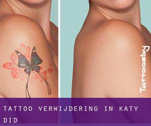 Tattoo verwijdering in Katy Did