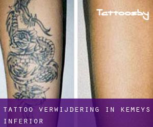 Tattoo verwijdering in Kemeys Inferior