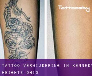 Tattoo verwijdering in Kennedy Heights (Ohio)