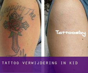 Tattoo verwijdering in Kid