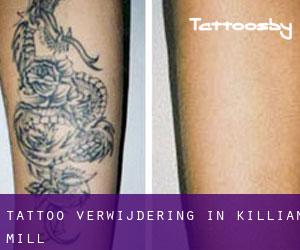 Tattoo verwijdering in Killian Mill