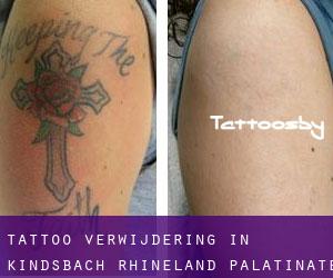Tattoo verwijdering in Kindsbach (Rhineland-Palatinate)