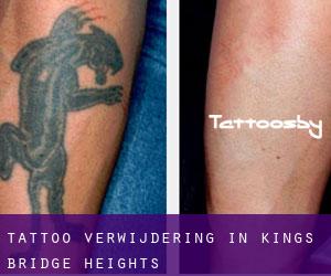 Tattoo verwijdering in Kings Bridge Heights