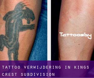Tattoo verwijdering in Kings Crest Subdivision