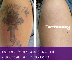 Tattoo verwijdering in Kirktown of Deskford