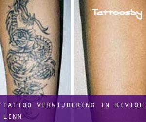 Tattoo verwijdering in Kiviõli linn