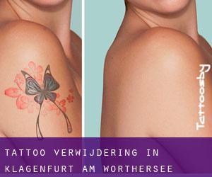 Tattoo verwijdering in Klagenfurt am Wörthersee