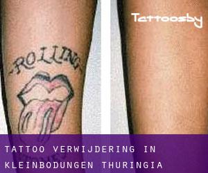 Tattoo verwijdering in Kleinbodungen (Thuringia)
