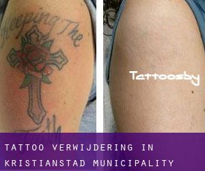 Tattoo verwijdering in Kristianstad Municipality