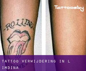 Tattoo verwijdering in L-Imdina
