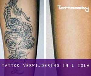 Tattoo verwijdering in L-Isla