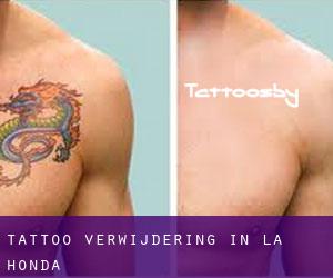 Tattoo verwijdering in La Honda