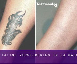 Tattoo verwijdering in la Masó