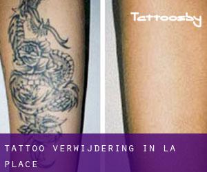 Tattoo verwijdering in La Place