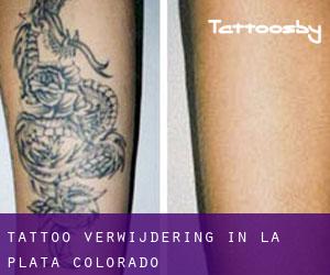 Tattoo verwijdering in La Plata (Colorado)